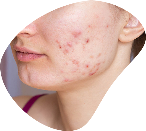 Acne behandeling gezicht